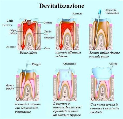 Schema della devitalizzazione dentale