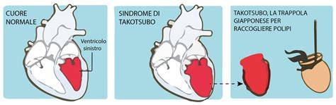 Forma del ventricolo sinistro nella sindrome Takotsubo